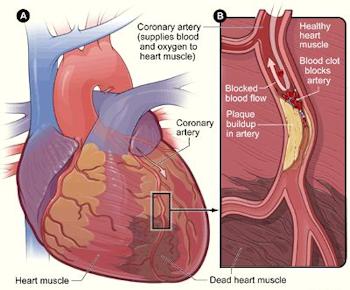 Blocked Arteries